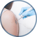 Tattoo Removal
